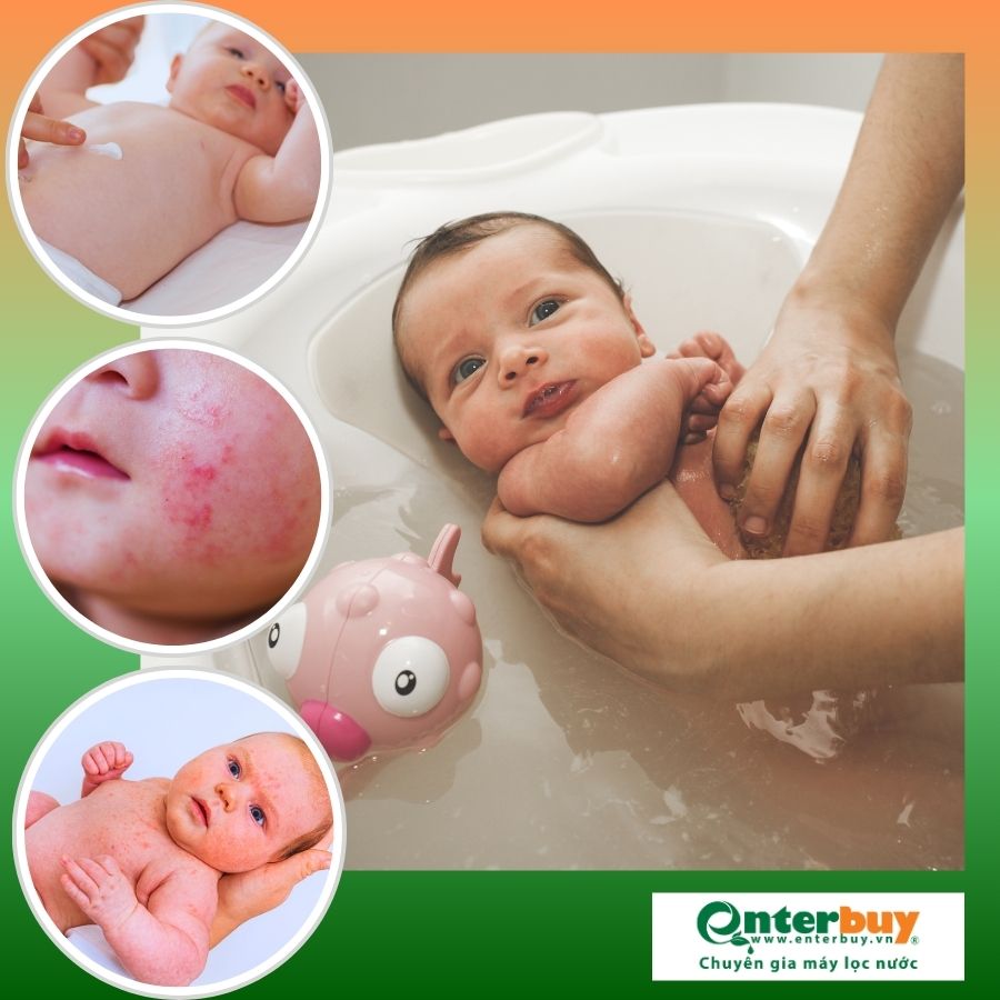 Trẻ có thể bị viêm da dị ứng nếu tắm bằng nước máy không sạch