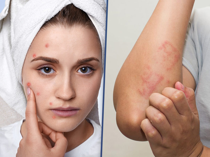 Dị ứng do nước chứa clo dư vượt ngưỡng